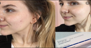 İmex krem yüzde kaç saat kalmalı?